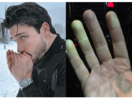 Andrea Del Corso di Uomini e Donne malattia: "ho sofferto della Sindrome di Raynaud"