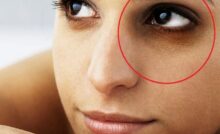Come eliminare le Occhiaie in Modo Naturale: Rimedi e Prevenzione